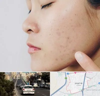 دکتر جوش صورت در خطیب تبریز