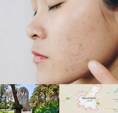 دکتر جوش صورت در نیشابور