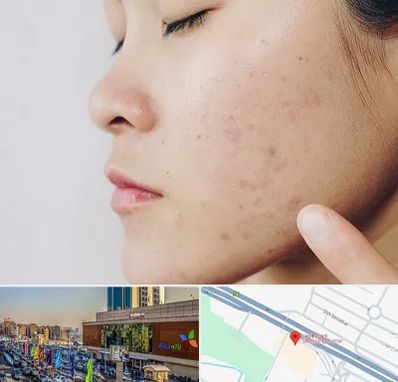 دکتر جوش صورت در لاله پارک تبریز