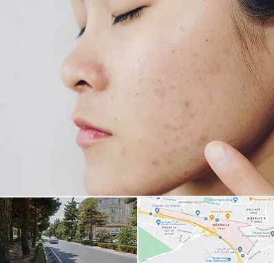 دکتر جوش صورت در مهرویلا کرج