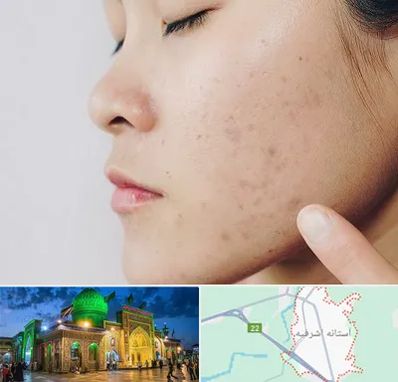 دکتر جوش صورت در آستانه اشرفیه