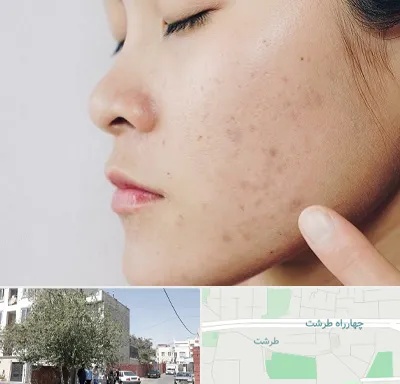 دکتر جوش صورت در طرشت