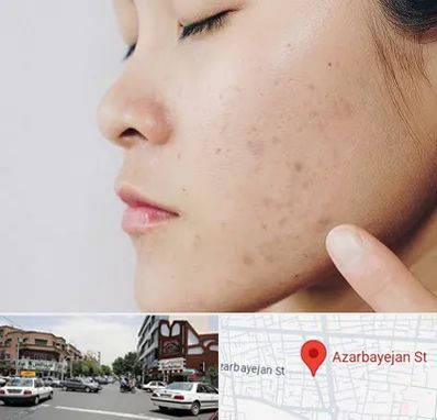 دکتر جوش صورت در خیابان آذربایجان