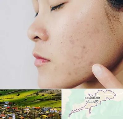 دکتر جوش صورت در کلاردشت