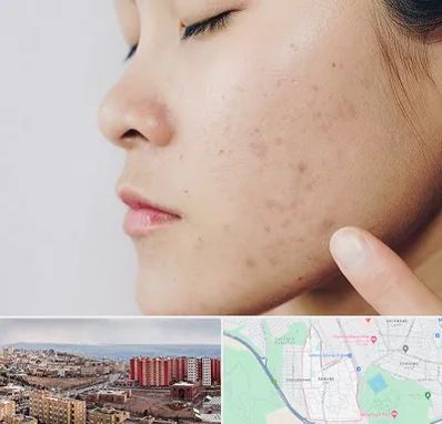 دکتر جوش صورت در سهند تبریز