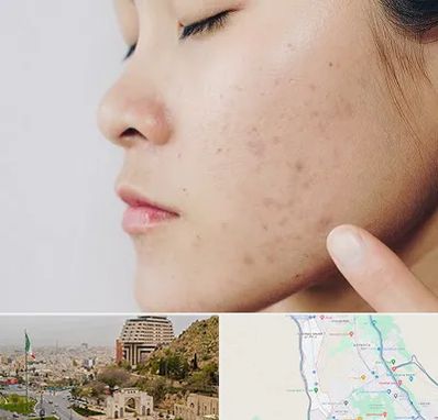 دکتر جوش صورت در فرهنگ شهر شیراز