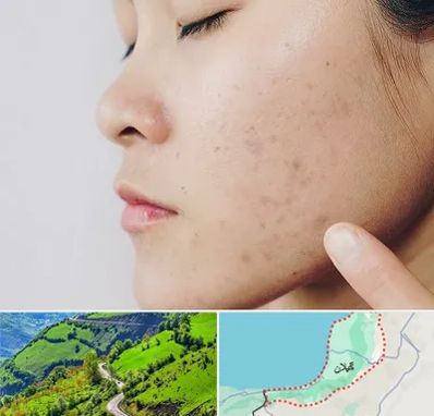 دکتر جوش صورت در گیلان