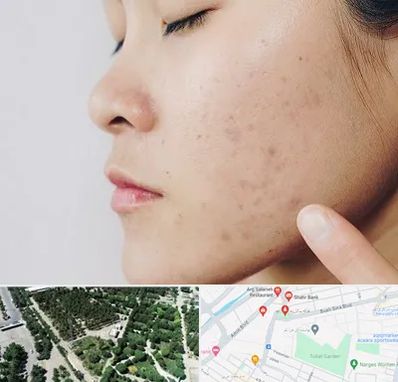 دکتر جوش صورت در سالاریه قم