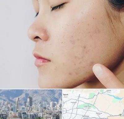 دکتر جوش صورت در شمال شرق تهران