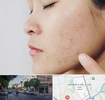 دکتر جوش صورت در شهرک ولیعصر