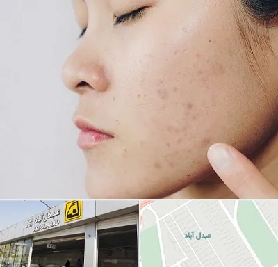دکتر جوش صورت در عبدل آباد