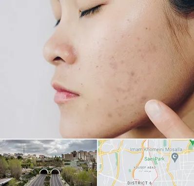 دکتر جوش صورت در یوسف آباد 