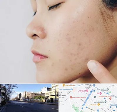 دکتر جوش صورت در خیابان ملاصدرا شیراز