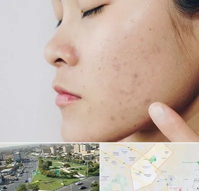 دکتر جوش صورت در کمال شهر کرج