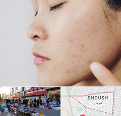 دکتر جوش صورت در شوش