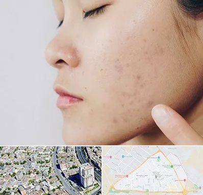 دکتر جوش صورت در قاسم آباد مشهد