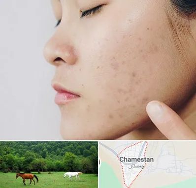 دکتر جوش صورت در چمستان