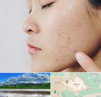 دکتر جوش صورت در مرند