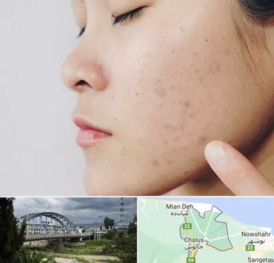 دکتر جوش صورت در چالوس