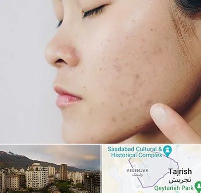 دکتر جوش صورت در زعفرانیه 