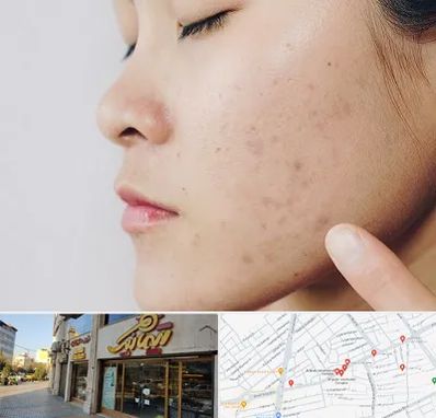 دکتر جوش صورت در عطاران قم