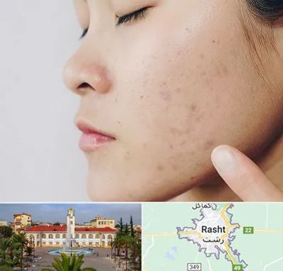 دکتر جوش صورت در رشت