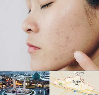 دکتر جوش صورت در زنجان