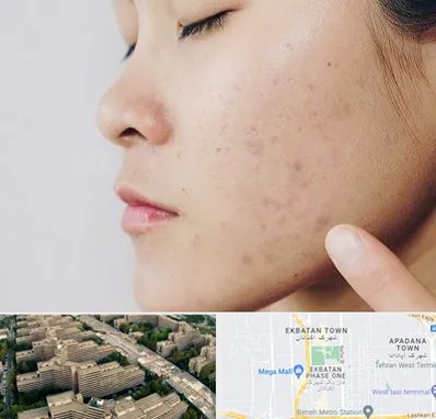 دکتر جوش صورت در اکباتان 