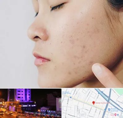 دکتر جوش صورت در آبرسان تبریز