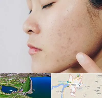 دکتر جوش صورت در مهاباد