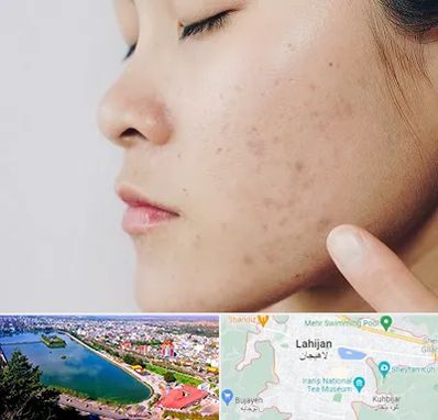 دکتر جوش صورت در لاهیجان