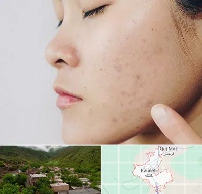 دکتر جوش صورت در کلاله