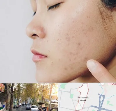 دکتر جوش صورت در کاشانک