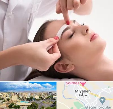 اپیلاسیون در میانه