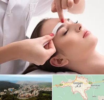 اپیلاسیون در گرگان