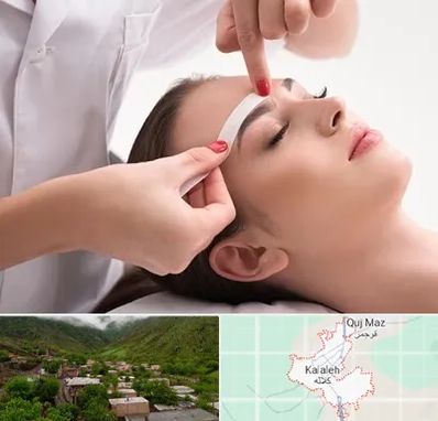 اپیلاسیون در کلاله