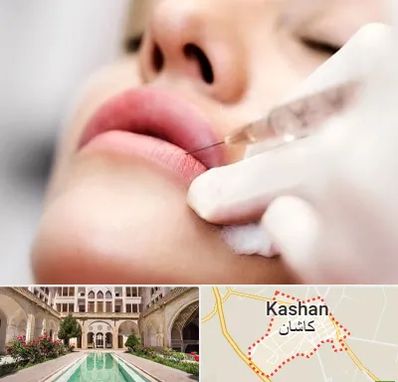 کلینیک تزریق ژل لب در کاشان