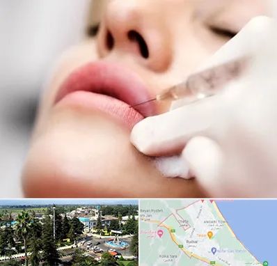 کلینیک تزریق ژل لب در رودسر
