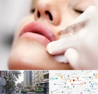 کلینیک تزریق ژل لب در فاطمی