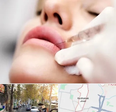 کلینیک تزریق ژل لب در کاشانک