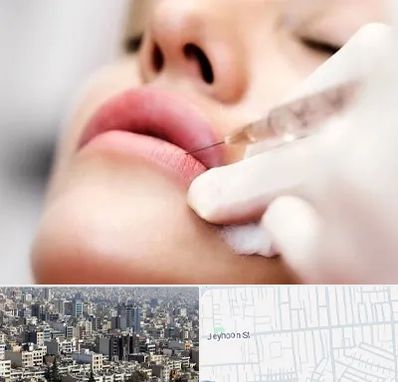کلینیک تزریق ژل لب در جیحون