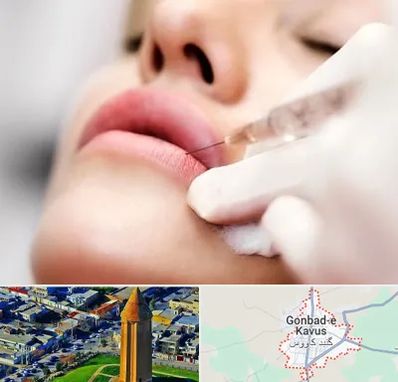 کلینیک تزریق ژل لب در گنبد کاووس