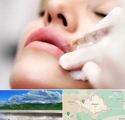 کلینیک تزریق ژل لب در مرند
