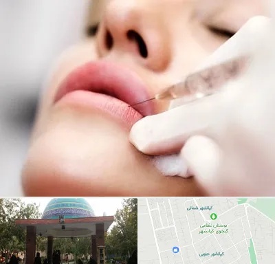 کلینیک تزریق ژل لب در کیانشهر