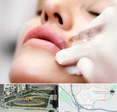 کلینیک تزریق ژل لب در مرزداران تبریز