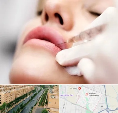 کلینیک تزریق ژل لب در فاز سه اندیشه