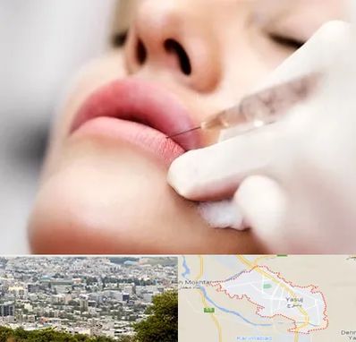 کلینیک تزریق ژل لب در یاسوج