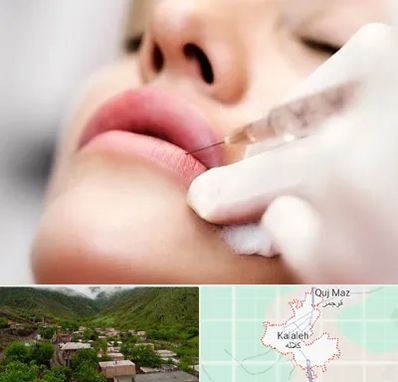 کلینیک تزریق ژل لب در کلاله