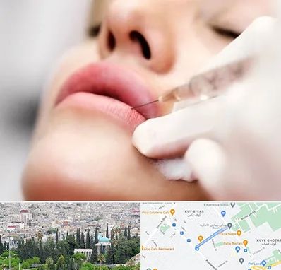 کلینیک تزریق ژل لب در محلاتی شیراز