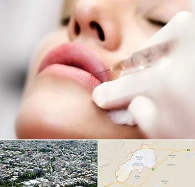 کلینیک تزریق ژل لب در شاهرود